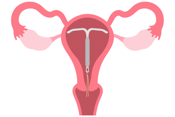 Why the Copper IUD is not a Safe Form of Birth Control: complications of the copper IUD include permanent infertility, anemia - due to the relationship between copper and iron metabolism, As well as cancer, hysterectomy, infection, chronic abdominal pain, vaginal bleeding and pelvic inflammatory disease (PID)